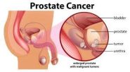 Il massaggio prostatico serve principalmente a drenare i liquidi in eccesso e i residui accumulati nella prostata, utile nel trattamento di prostatiti croniche e per alleviare sintomi dell'ipertrofia prostatica benigna (IPB), come difficoltà urinarie