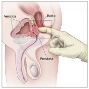 Il massaggio prostatico serve principalmente a drenare i liquidi in eccesso e i residui accumulati nella prostata, utile nel trattamento di prostatiti croniche e per alleviare sintomi dell'ipertrofia prostatica benigna (IPB), come difficoltà urinarie 