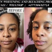 Permanent Skin Lightening Skin Whitening Products +27738432716

Permanent Skin Lightening Skin Whitening Pills Injection IN Pretoria Johannesburg 