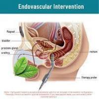 BENEFICI DELLA PROSTATA
favorisce un buon flusso sanguigno a livello della prostata e del perineo che aiuta a prevenire e contrastare le infezioni del tratto urinario; migliora il controllo della minzione poiché riduce i problemi derivanti dall'ingrossam