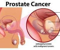 
La prostata è una parte fondamentale dell’apparato genitale maschile che col tempo può ingrossarsi e dar luogo a problemi, tra cui l’incontinenza. È possibile alleviare tali problemi con il massaggio prostatico. Scopri di cosa si tratta e come funziona.
