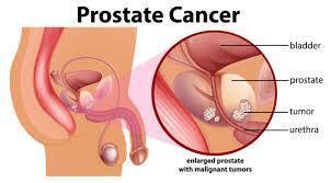Il massaggio prostatico serve principalmente a drenare i liquidi in eccesso e i residui accumulati nella prostata, utile nel trattamento di prostatiti croniche e per alleviare sintomi dell'ipertrofia prostatica benigna (IPB), come difficoltà urinarie